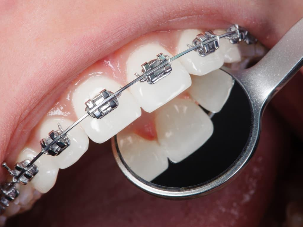 Ortodoncia visible braquets